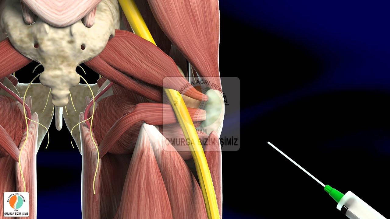 (Siyatik Sinir) Piriformis Enjeksiyonu - Marmara Ağrı Merkezi